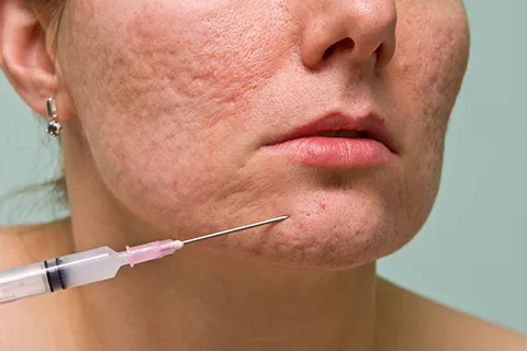 open pores treatment